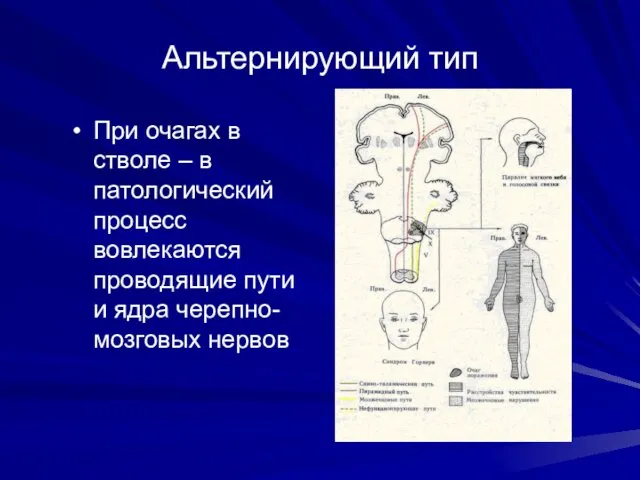 Альтернирующий тип При очагах в стволе – в патологический процесс