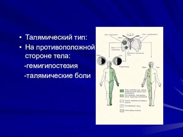 Талямический тип: На противоположной стороне тела: -гемигипостезия -талямические боли