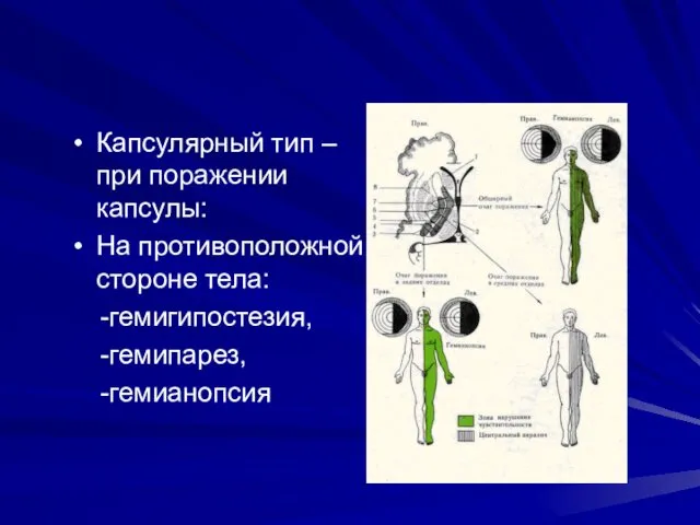 Капсулярный тип – при поражении капсулы: На противоположной стороне тела: -гемигипостезия, -гемипарез, -гемианопсия