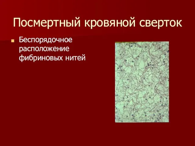 Посмертный кровяной сверток Беспорядочное расположение фибриновых нитей