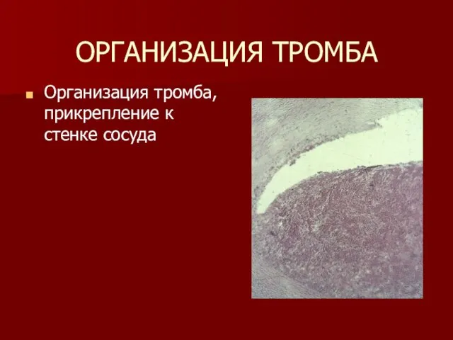 ОРГАНИЗАЦИЯ ТРОМБА Организация тромба, прикрепление к стенке сосуда