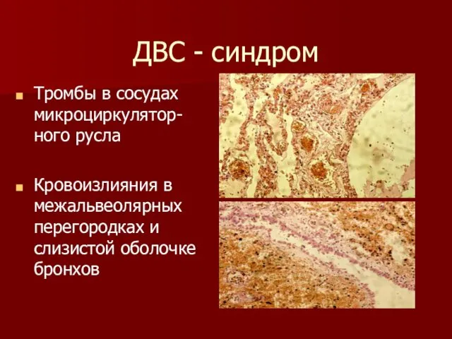 ДВС - синдром Тромбы в сосудах микроциркулятор-ного русла Кровоизлияния в межальвеолярных перегородках и слизистой оболочке бронхов