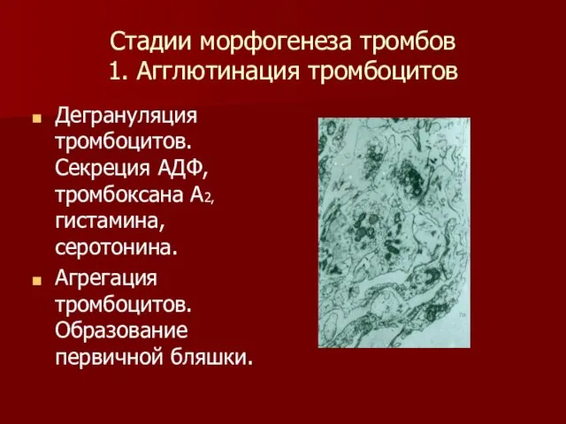 Стадии морфогенеза тромбов 1. Агглютинация тромбоцитов Дегрануляция тромбоцитов. Секреция АДФ,