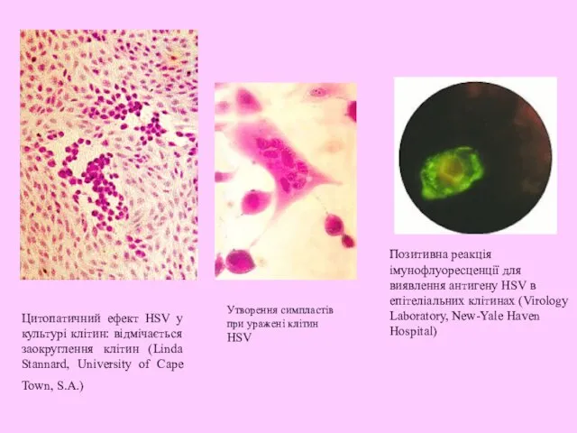 Цитопатичний ефект HSV у культурі клітин: відмічається заокруглення клітин (Linda