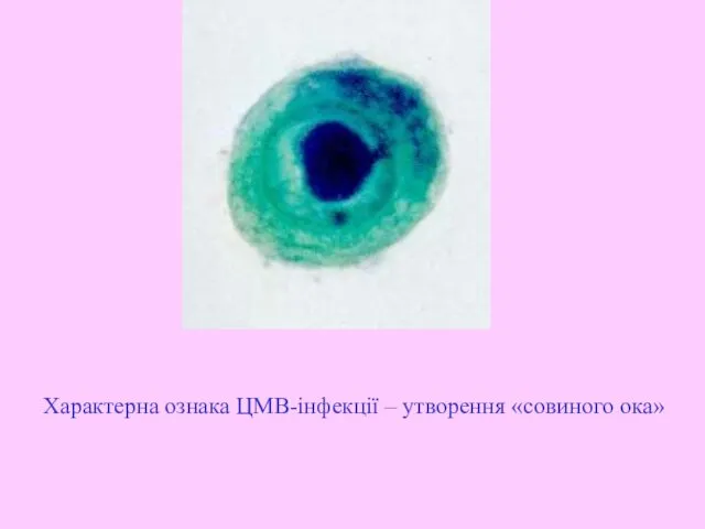 Характерна ознака ЦМВ-інфекції – утворення «совиного ока»