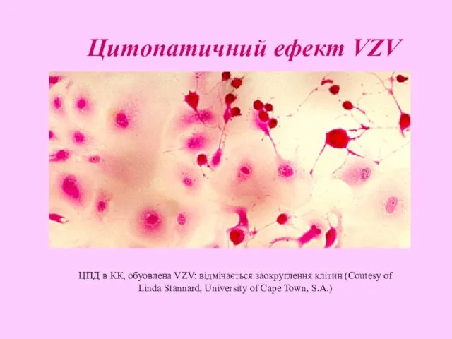 ЦПД в КК, обуовлена VZV: відмічається заокруглення клітин (Coutesy of
