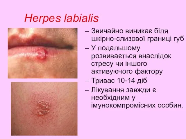 Herpes labialis Звичайно виникає біля шкірно-слизової границі губ У подальшому