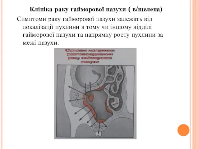 Клініка раку гайморової пазухи ( в/щелепа) Симптоми раку гайморової пазухи