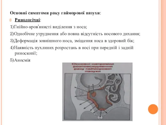 Основні симптоми раку гайморової пазухи: Ринологічні: 1)Гнійно-кров’янисті виділення з носа;