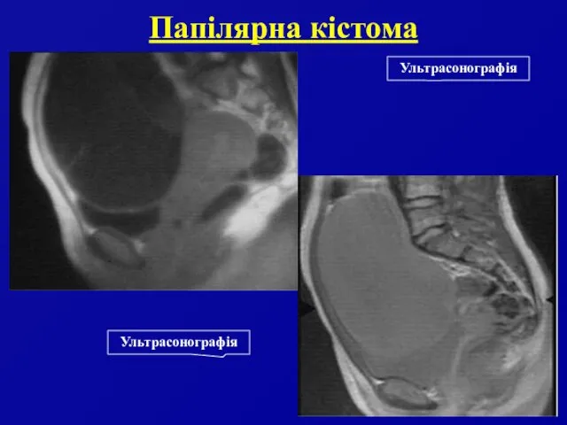 Папілярна кістома Ультрасонографія Ультрасонографія