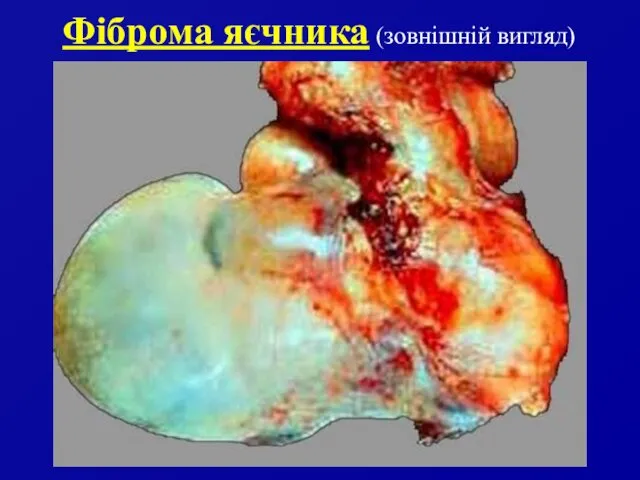 Фіброма яєчника (зовнішній вигляд)