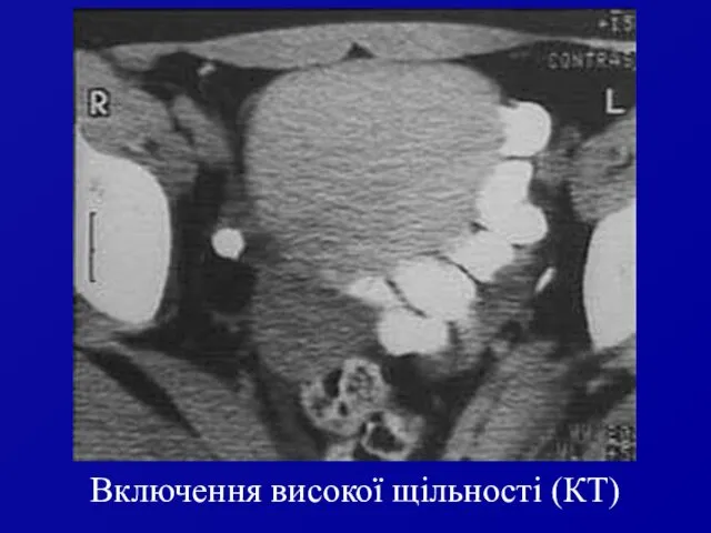 Включення високої щільності (КТ)