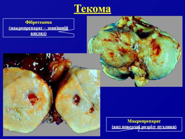 Текома Фібротекома (макропрепарат – зовнішній вигляд) Макропрепарат (вид поверхні розрізу пухлини)