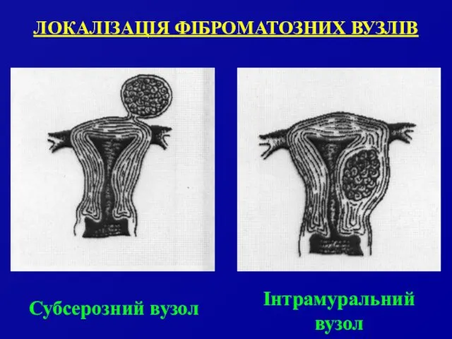 ЛОКАЛІЗАЦІЯ ФІБРОМАТОЗНИХ ВУЗЛІВ Інтрамуральний вузол Субсерозний вузол