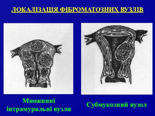 ЛОКАЛІЗАЦІЯ ФІБРОМАТОЗНИХ ВУЗЛІВ Множинні інтрамуральні вузли Субмукозний вузол