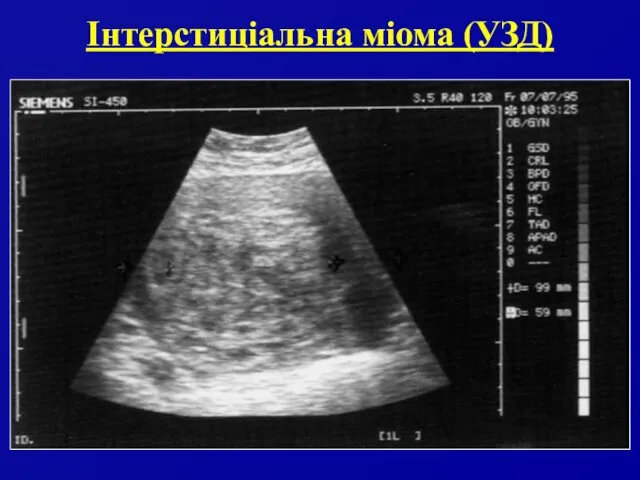 Інтерстиціальна міома (УЗД)