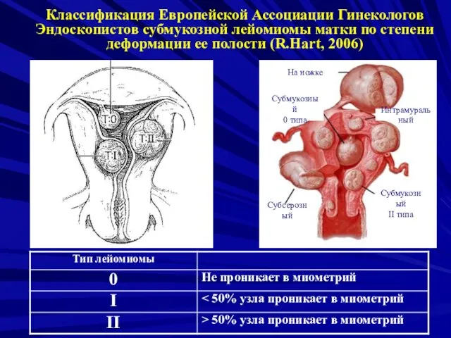 Классификация Европейской Ассоциации Гинекологов Эндоскопистов субмукозной лейомиомы матки по степени