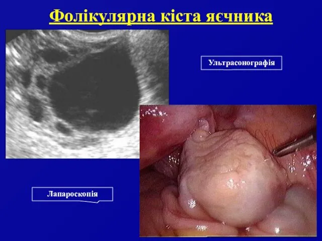 Фолікулярна кіста яєчника Лапароскопія Ультрасонографія