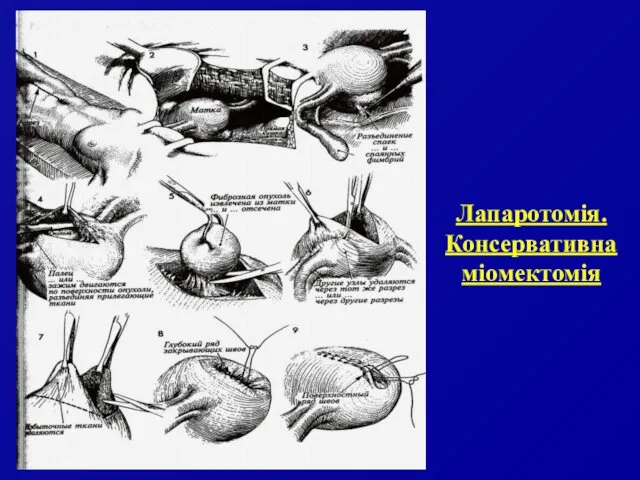 Лапаротомія. Консервативна міомектомія