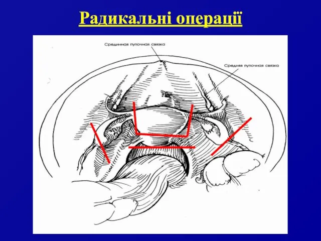 Радикальні операції