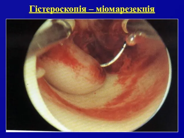 Гістероскопія – міомарезекція