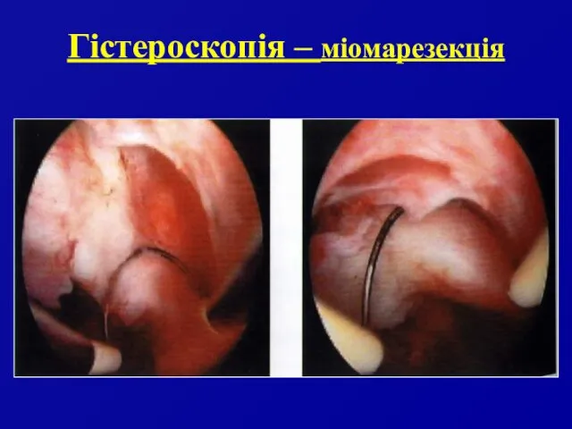 Гістероскопія – міомарезекція