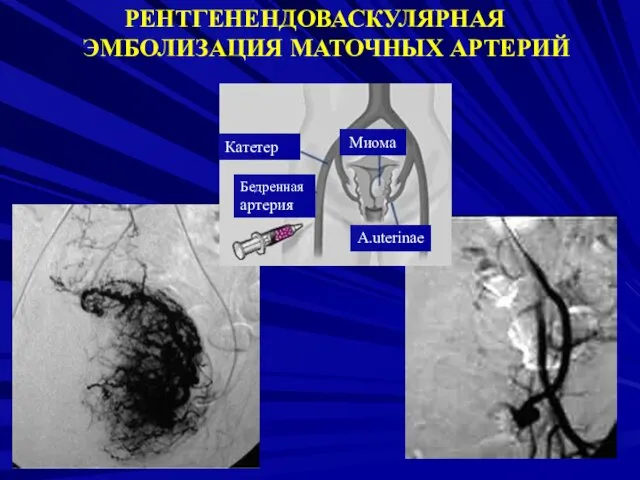 РЕНТГЕНЕНДОВАСКУЛЯРНАЯ ЭМБОЛИЗАЦИЯ МАТОЧНЫХ АРТЕРИЙ Бедренная артерия Катетер Миома A.uterinae