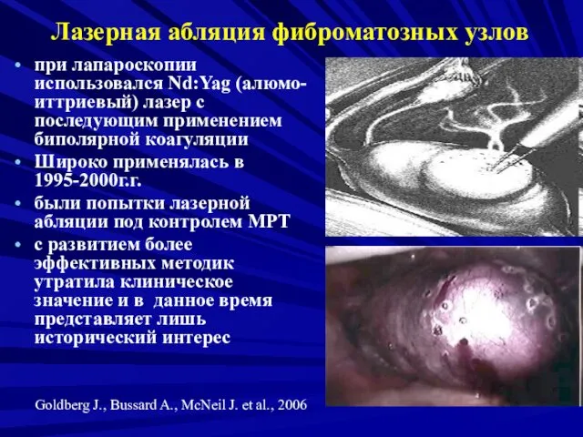 Лазерная абляция фиброматозных узлов при лапароскопии использовался Nd:Yag (алюмо-иттриевый) лазер