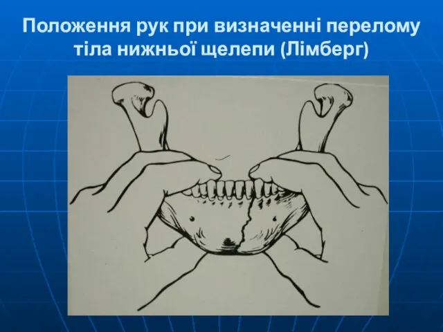 Положення рук при визначенні перелому тіла нижньої щелепи (Лімберг)
