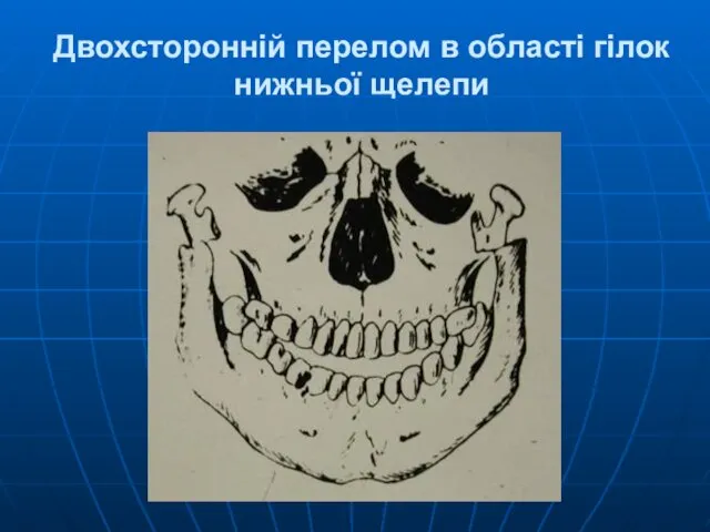 Двохсторонній перелом в області гілок нижньої щелепи