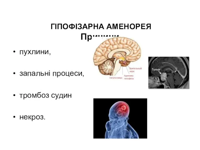 ГІПОФІЗАРНА АМЕНОРЕЯ Причини пухлини, запальні процеси, тромбоз судин некроз.