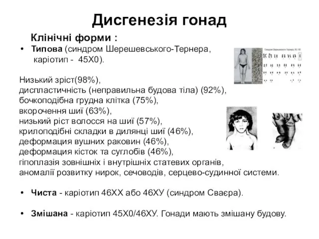 Дисгенезія гонад Клінічні форми : Типова (синдром Шерешевського-Тернера, каріотип -