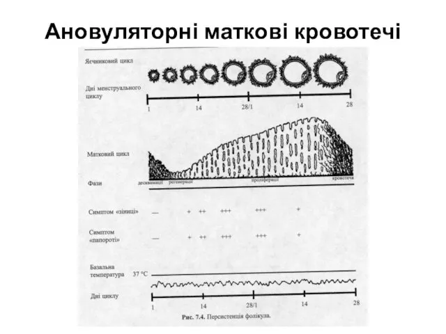 Ановуляторні маткові кровотечі