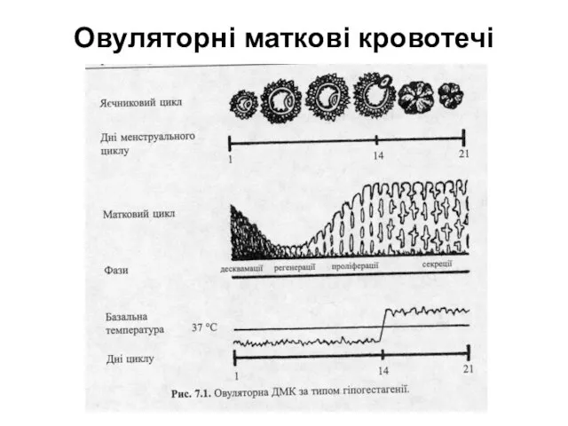 Овуляторні маткові кровотечі