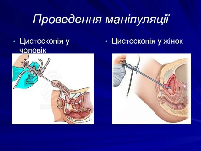 Проведення маніпуляції Цистоскопія у жінок Цистоскопія у чоловік