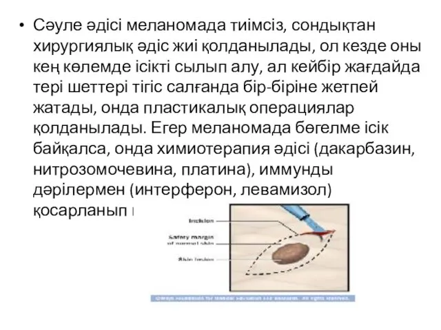 Сәуле әдісі меланомада тиімсіз, сондықтан хирургиялық әдіс жиі қолданылады, ол