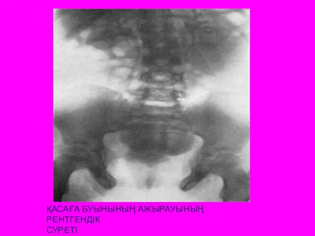 ҚАСАҒА БУЫНЫНЫҢ АЖЫРАУЫНЫҢ РЕНТГЕНДІК СУРЕТІ.