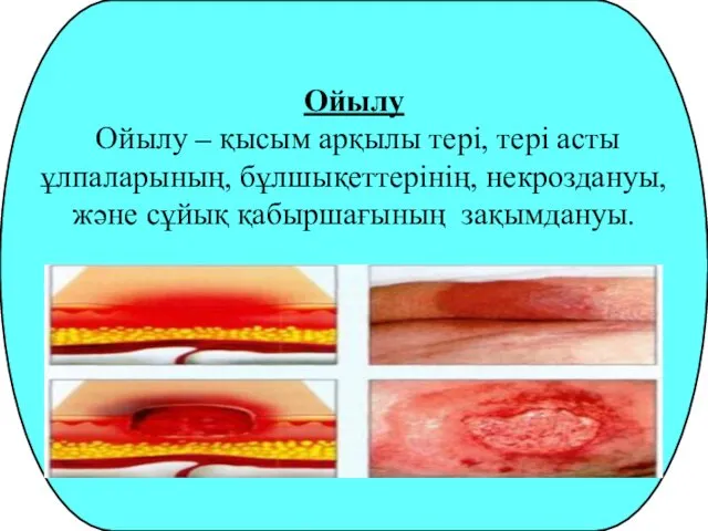 Ойылу Ойылу – қысым арқылы тері, тері асты ұлпаларының, бұлшықеттерінің, некроздануы, және сұйық қабыршағының зақымдануы.