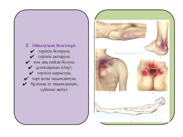 Ойылудың белгілері: терінің бозаруы; терінің қызаруы; көк дақ пайда болуы;