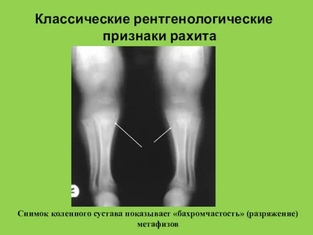 Классические рентгенологические признаки рахита Снимок коленного сустава показывает «бахромчастость» (разряжение) метафизов