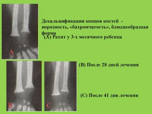 Декальцификация концов костей - порозность, «бахромчатость», блюдцеобразная форма (A) Рахит