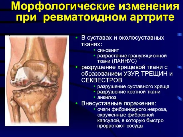 В суставах и околосуставных тканях: синовиит разрастание грануляционной ткани (ПАННУС)