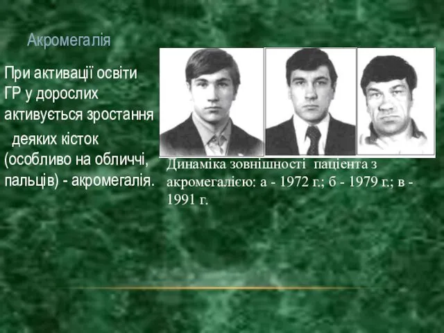 Акромегалія При активації освіти ГР у дорослих активується зростання деяких