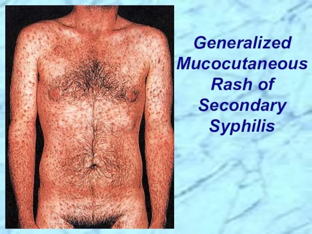 Generalized Mucocutaneous Rash of Secondary Syphilis
