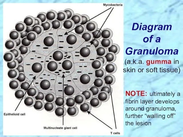 Diagram of a Granuloma (a.k.a. gumma in skin or soft