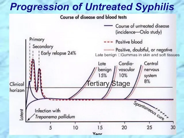 Progression of Untreated Syphilis Tertiary Stage Late benign ?Gummas in skin and soft tissues