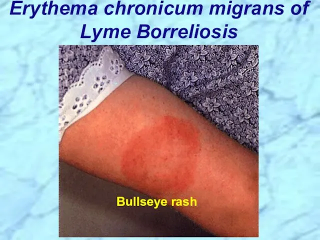 Erythema chronicum migrans of Lyme Borreliosis Bullseye rash