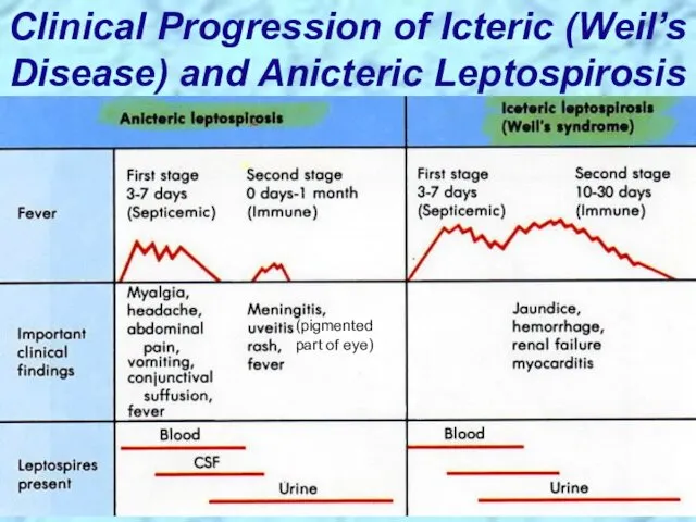 Clinical Progression of Icteric (Weil’s Disease) and Anicteric Leptospirosis (pigmented part of eye)