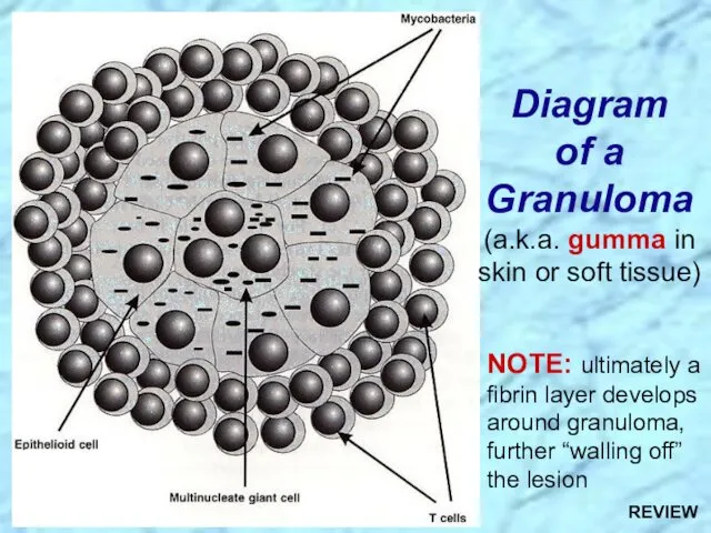 Diagram of a Granuloma (a.k.a. gumma in skin or soft