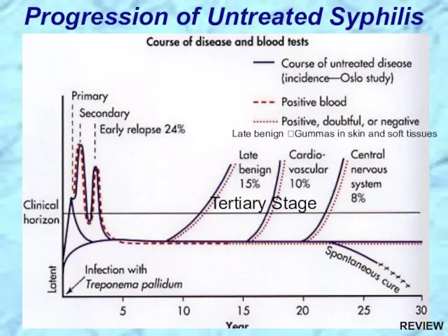 Progression of Untreated Syphilis Tertiary Stage Late benign ?Gummas in skin and soft tissues REVIEW